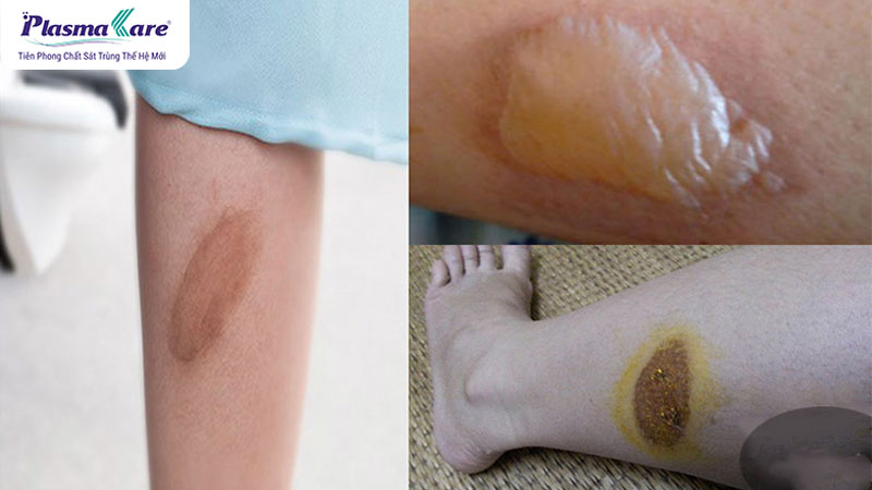 Bỏng bô xe máy: Nguyên nhân, tác hại và cách phòng tránh