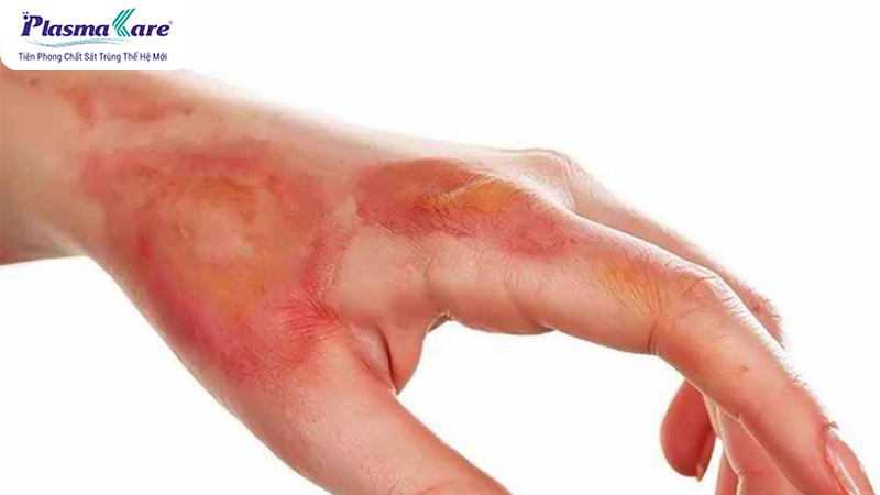 Bỏng nước sôi có để lại sẹo không? Cách chữa trị không để lại sẹo