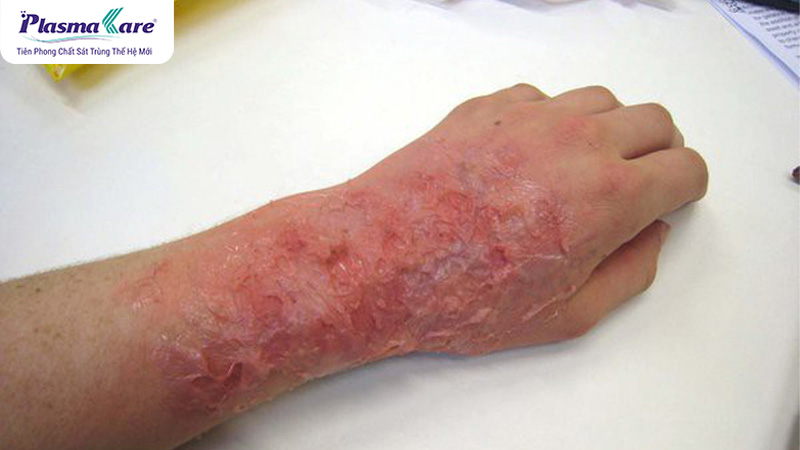 Bỏng nước sôi có để lại sẹo không? Cách chữa trị không để lại sẹo