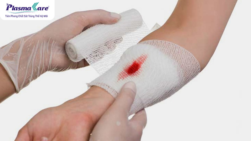 Bỏng nước sôi có để lại sẹo không? Cách chữa trị không để lại sẹo