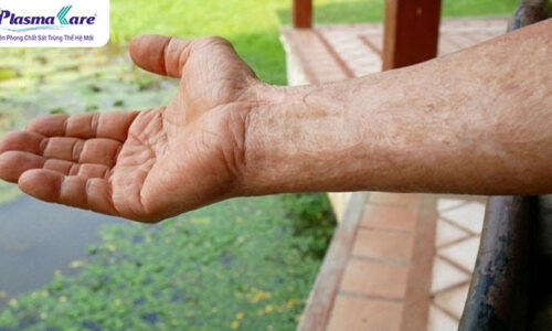 Bỏng nước sôi có để lại sẹo không? Cách chữa trị không để lại sẹo