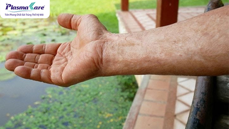 Bỏng nước sôi có để lại sẹo không? Cách chữa trị không để lại sẹo