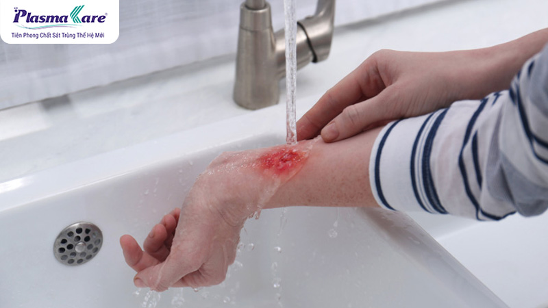 Hướng dẫn cách trị bỏng nước sôi tại nhà nhanh khỏi nhất