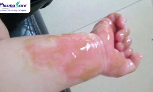 Hướng dẫn cách trị bỏng nước sôi tại nhà nhanh khỏi nhất