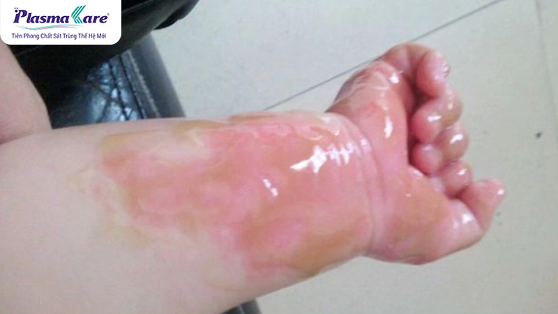 Hướng dẫn cách trị bỏng nước sôi tại nhà nhanh khỏi nhất