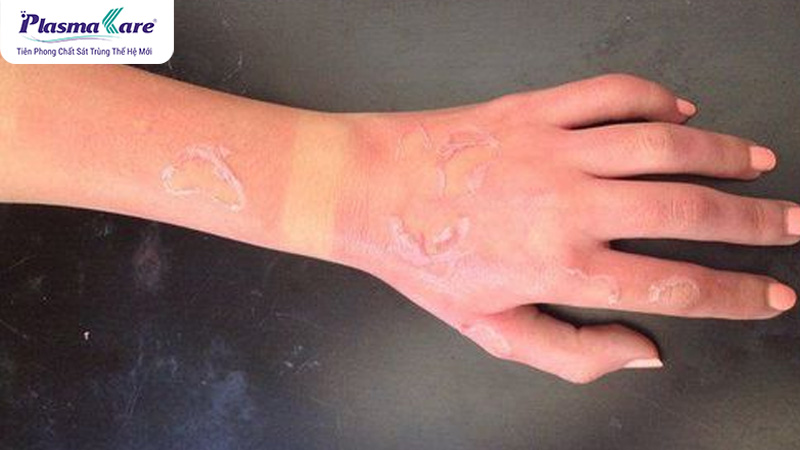 Hướng dẫn cách trị bỏng nước sôi tại nhà nhanh khỏi nhất