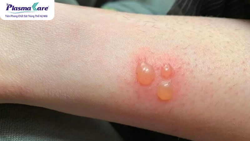 Cách trị vết bỏng không để lại sẹo hiệu quả, an toàn ngay tại nhà