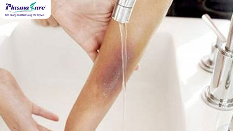 Hướng dẫn cách xử lý khi bị bỏng bô xe máy an toàn và hiệu quả