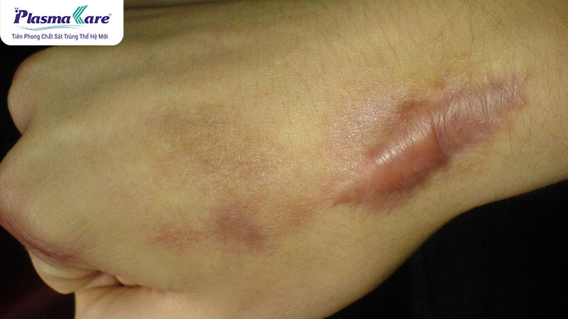 Cách trị vết bỏng không để lại sẹo hiệu quả, an toàn ngay tại nhà