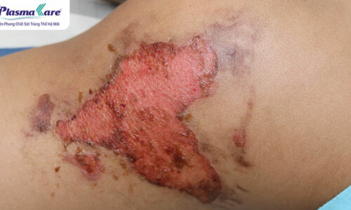 Hướng dẫn cách xử lý khi bị bỏng bô xe máy an toàn và hiệu quả