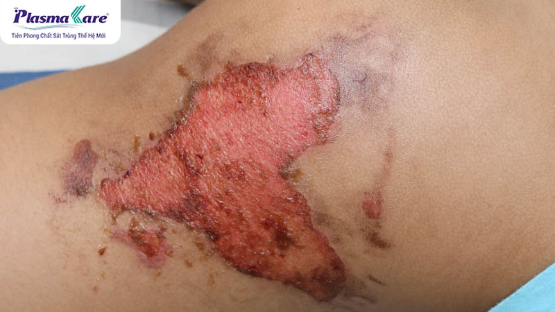 Hướng dẫn cách xử lý khi bị bỏng bô xe máy an toàn và hiệu quả