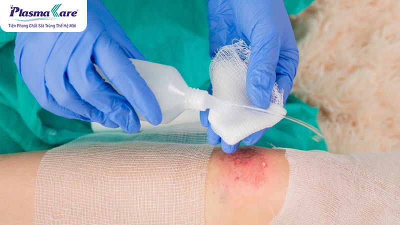 Hướng dẫn cách xử lý khi bị bỏng bô xe máy an toàn và hiệu quả