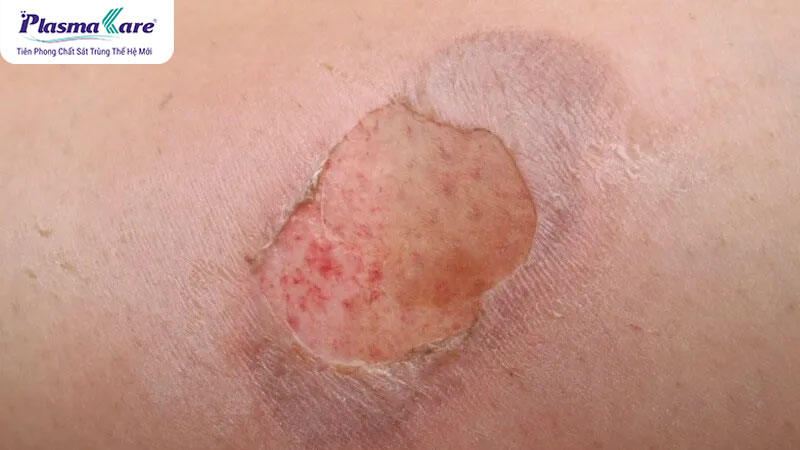 Hướng dẫn cách xử lý khi bị bỏng bô xe máy an toàn và hiệu quả