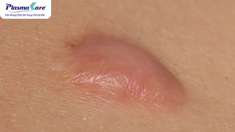 Cách trị sẹo bỏng bô, vết bỏng bô bị thâm đen hiệu quả nhanh