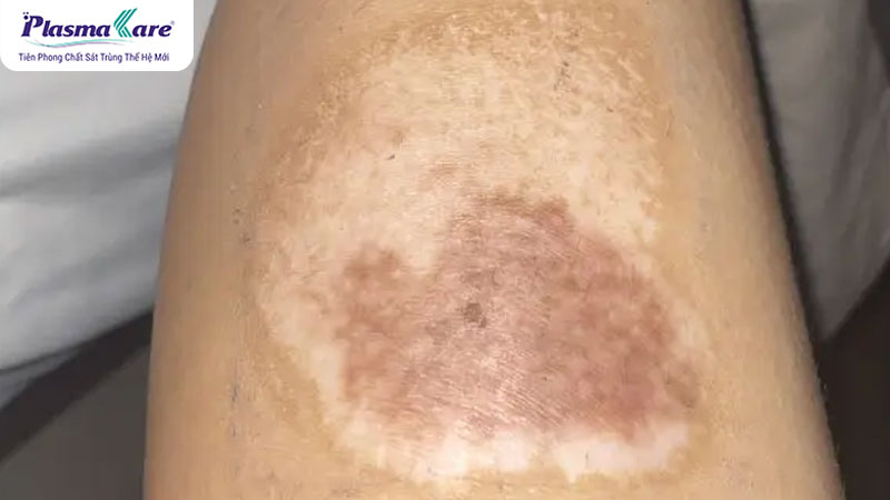 Cách trị sẹo bỏng bô, vết bỏng bô bị thâm đen hiệu quả nhanh