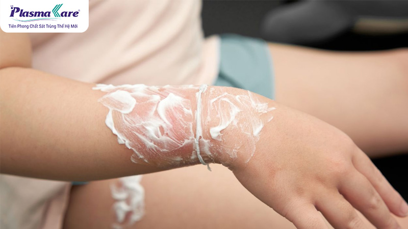 Cách điều trị và làm mờ sẹo bỏng nước sôi hiệu quả nhất