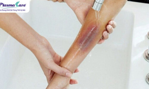 Cách điều trị và làm mờ sẹo bỏng nước sôi hiệu quả nhất