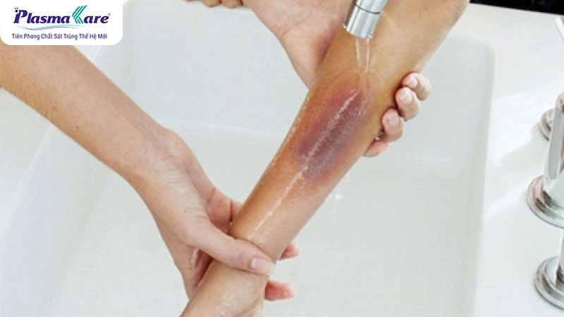 Cách điều trị và làm mờ sẹo bỏng nước sôi hiệu quả nhất