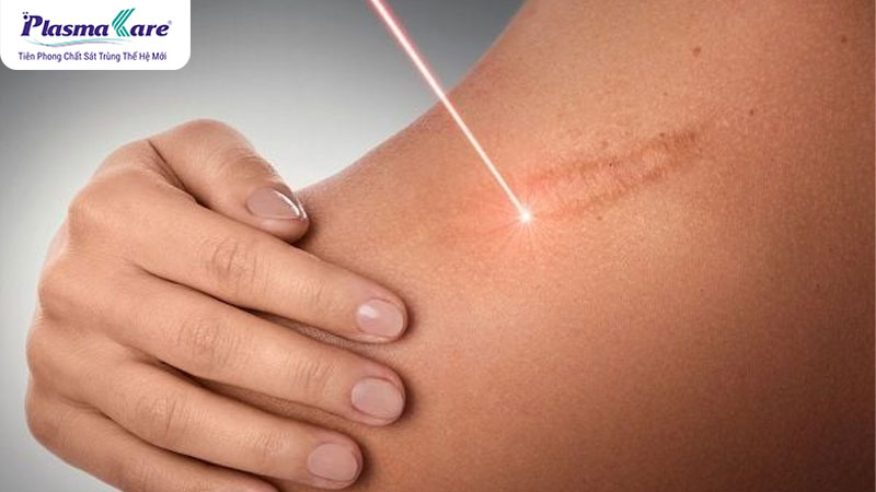 Sử dụng tia laser để tác động vào mô sẹo