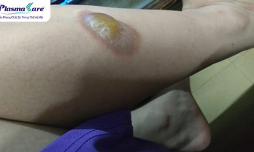 Hướng dẫn cách sơ cứu bỏng bô xe máy an toàn và tốt nhất Hướng dẫn cách sơ cứu bỏng bô xe máy an toàn và tốt nhất