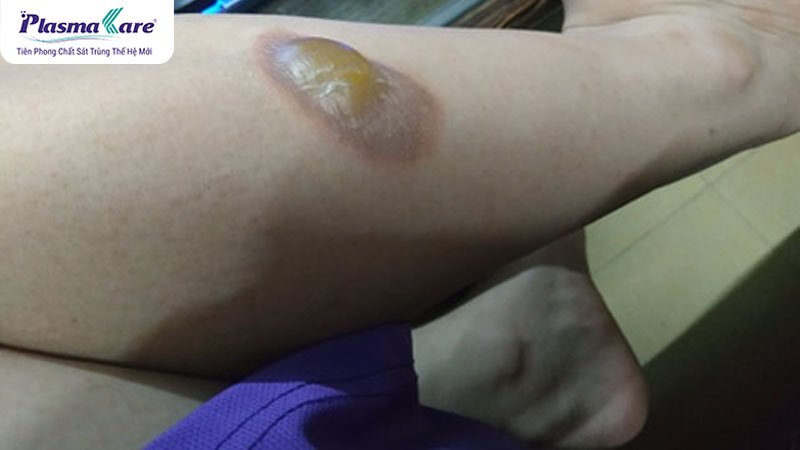 Sử dụng tia laser để tác động vào mô sẹo