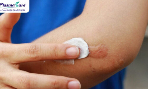 Điểm danh TOP 6 loại thuốc trị bỏng bô xe máy tốt nhất hiện nay