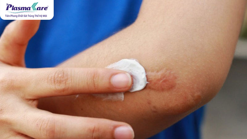 Cách xử lý bỏng bô xe máy bị phồng nước, vỡ và chảy nước vàng