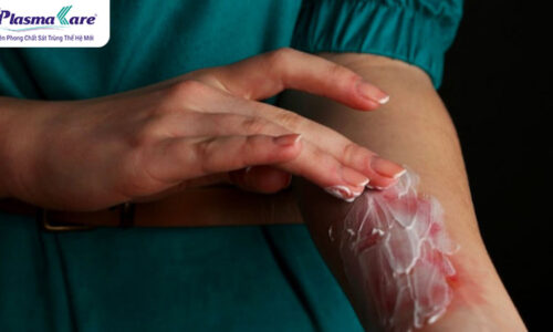 TOP 8 loại thuốc trị bỏng nước sôi tốt nhất thị trường hiện nay