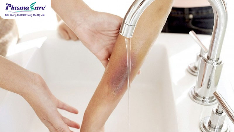 Hướng dẫn cách xử lý khi bị bỏng dầu ăn và sơ cứu an toàn