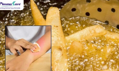 Hướng dẫn cách xử lý khi bị bỏng dầu ăn và sơ cứu an toàn