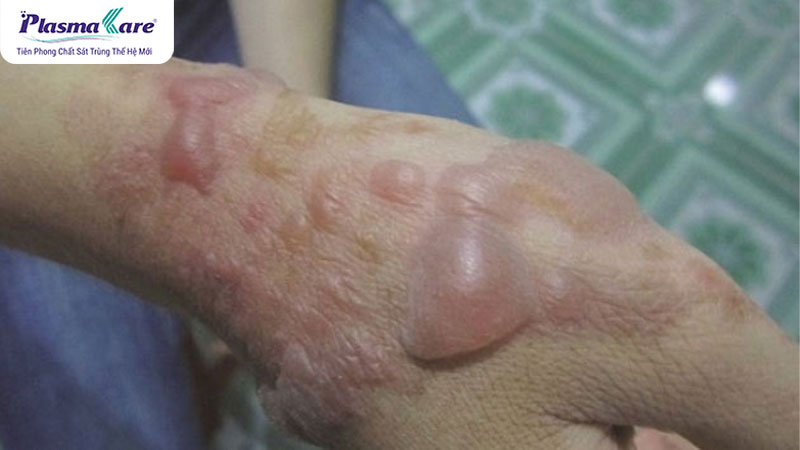 Bỏng dầu ăn có để lại sẹo không? 6 loại thuốc bôi bỏng dầu ăn hiệu quả nhất