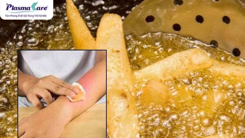 Hướng dẫn cách xử lý khi bị bỏng dầu ăn và sơ cứu an toàn
