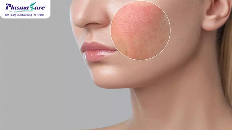 Bỏng tỏi: Nguyên nhân, triệu chứng và cách điều trị hiệu quả