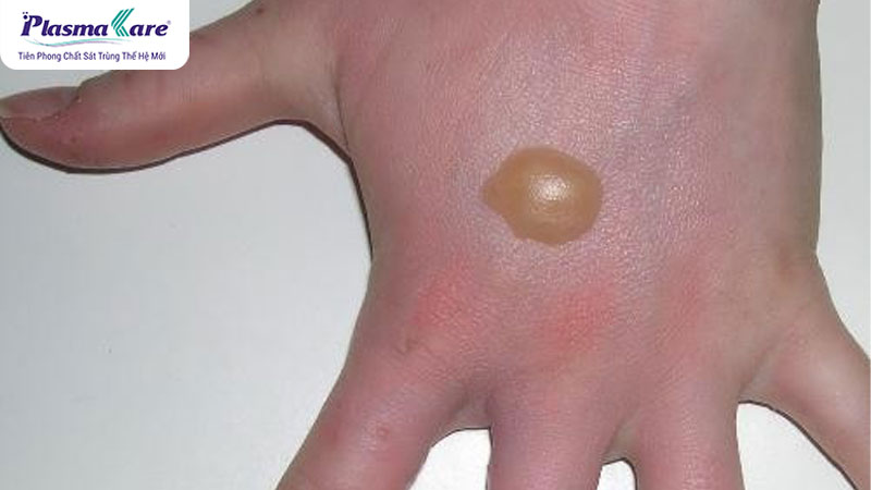 Bỏng tỏi: Nguyên nhân, triệu chứng và cách điều trị hiệu quả