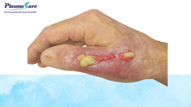 Bỏng tỏi: Nguyên nhân, triệu chứng và cách điều trị hiệu quả