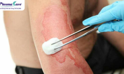 Cách chữa trị bỏng dầu ăn an toàn, nhanh khỏi, không để lại sẹo