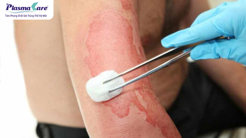 Cách chữa trị bỏng dầu ăn an toàn, nhanh khỏi, không để lại sẹo