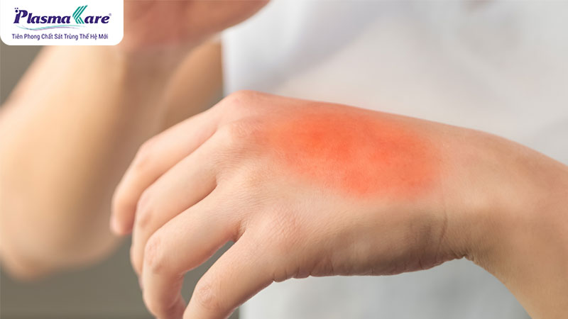 Các cấp độ bỏng: mức độ nghiêm trọng và cách điều trị