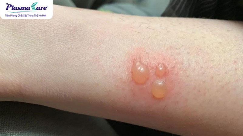 Các cấp độ bỏng: mức độ nghiêm trọng và cách điều trị