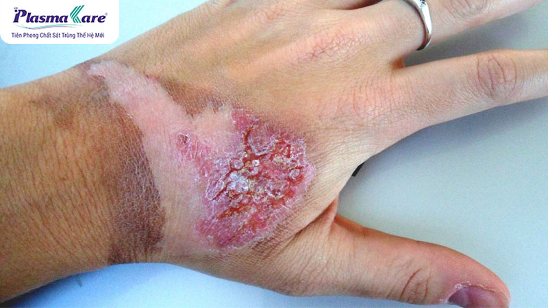 Các cấp độ bỏng: mức độ nghiêm trọng và cách điều trị