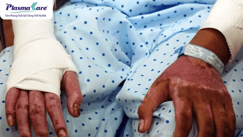 Các cấp độ bỏng: mức độ nghiêm trọng và cách điều trị