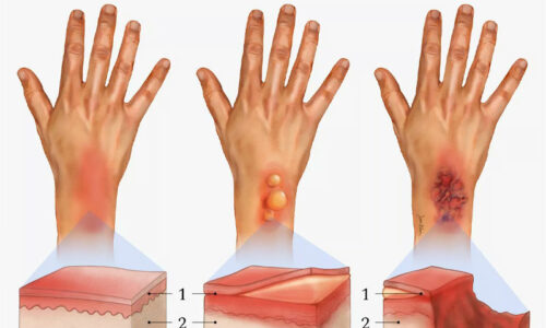 Các cấp độ bỏng: mức độ nghiêm trọng và cách điều trị