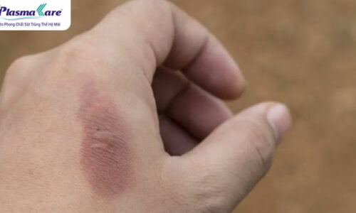 Vết bỏng bị thâm đen phải làm sao? Nên bôi gì để không bị sẹo?