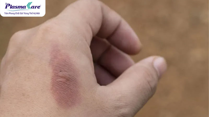 Vết bỏng bị thâm đen phải làm sao? Nên bôi gì để không bị sẹo?