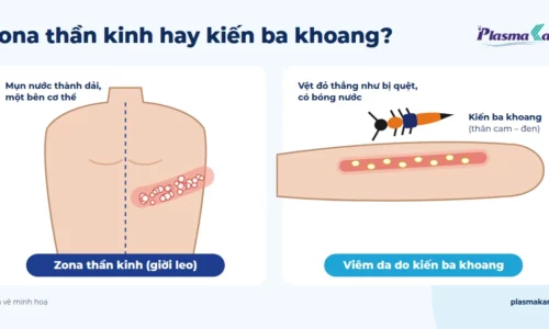 Phân biệt zona thần kinh (giời leo) và viêm da do kiến ba khoang