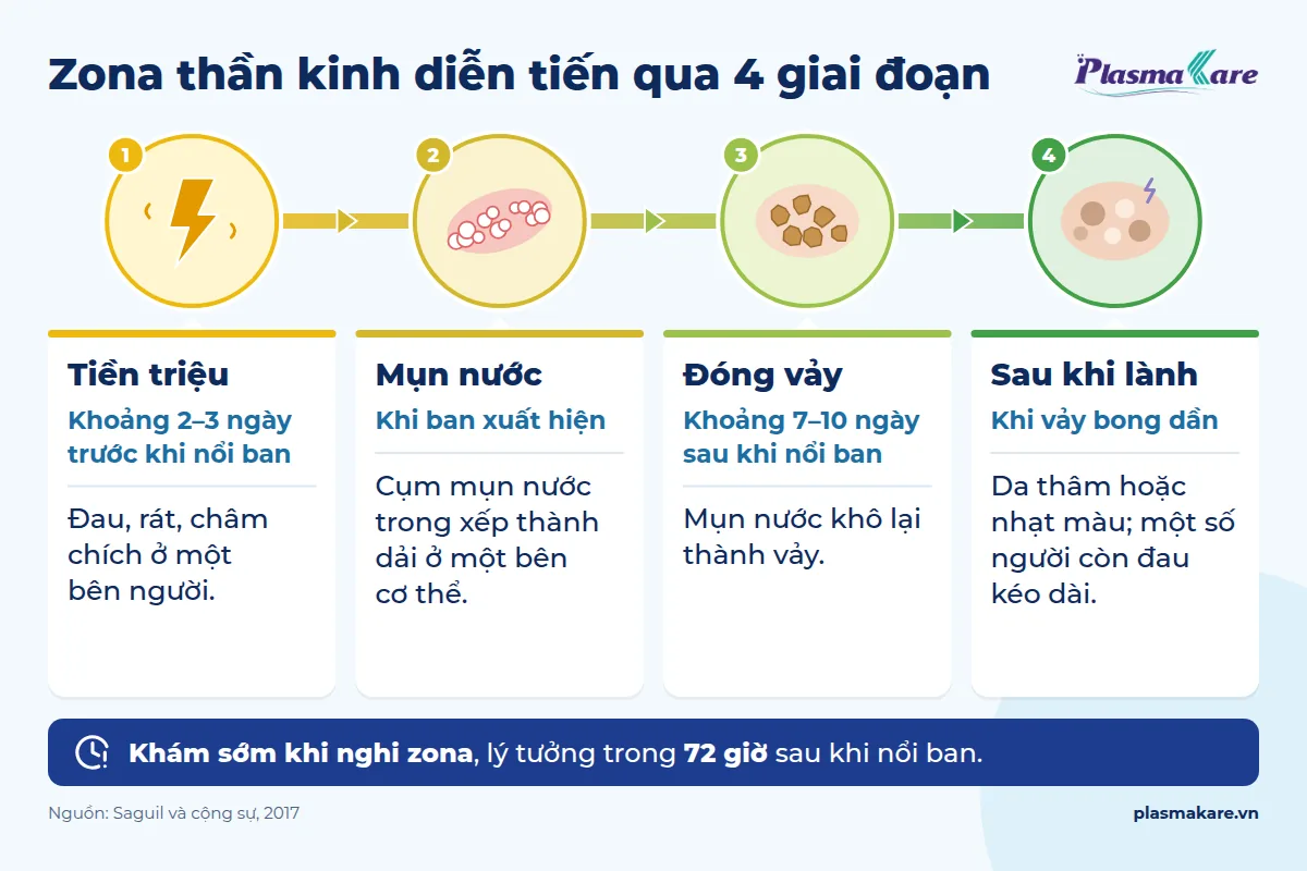 Infographic 4 giai đoạn zona thần kinh: tiền triệu, mụn nước, đóng vảy, sau khi lành