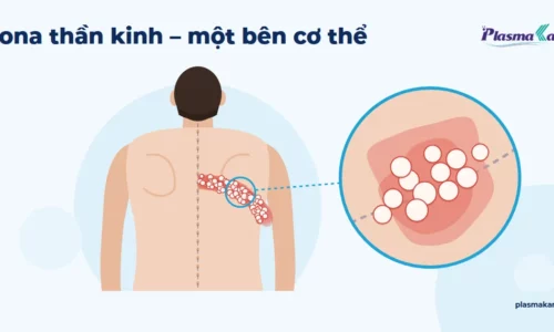 Zona thần kinh: dải mụn nước theo dây thần kinh ở một bên cơ thể