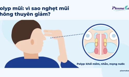 Polyp mũi: dấu hiệu gợi ý và vì sao nghẹt mũi không thuyên giảm Polyp mũi: dấu hiệu gợi ý và vì sao nghẹt mũi không thuyên giảm
