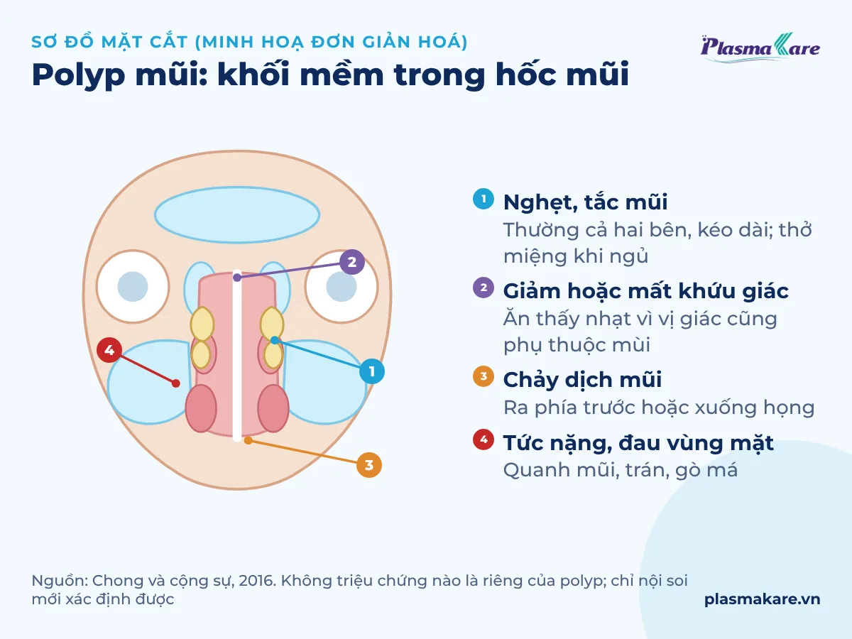 Sơ đồ mặt cắt trán hốc mũi và xoang có các khối polyp hai bên, chú thích bốn nhóm triệu chứng: nghẹt mũi, giảm khứu giác, chảy dịch, tức nặng vùng mặt