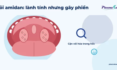Minh họa khoang họng nhìn từ miệng mở, hai amidan có vài hốc chứa cục nhỏ màu trắng ngà